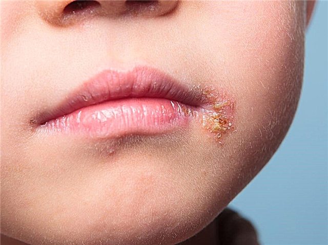 Ulcers on the child's body - why do sores get wet, do not heal