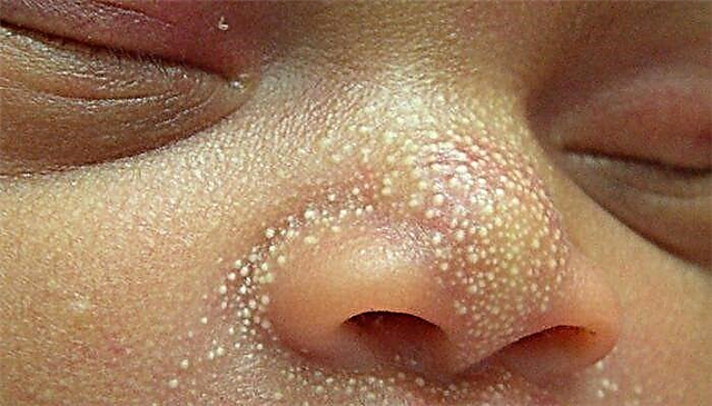 Espinillas en la cara de un recién nacido con cabezas blancas
