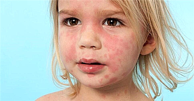 Petele roșii pe corpul unui copil - cauze de roșeață, plăci, iritații