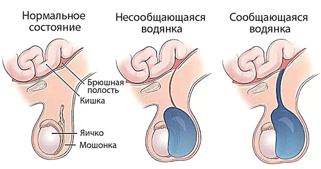 Hidropisia dos testículos em meninos recém-nascidos - o que é, sintomas e tratamento