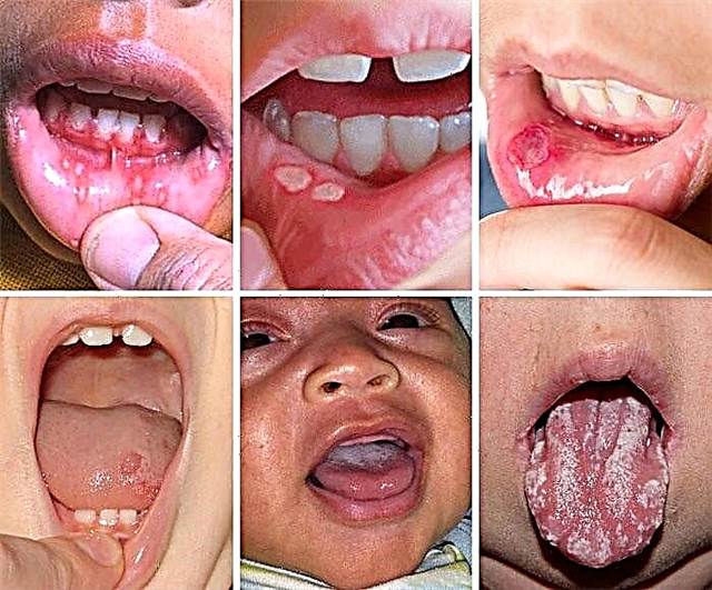 Επιληπτικές κρίσεις στις γωνίες του στόματος ενός παιδιού - λόγοι για τη θεραπεία
