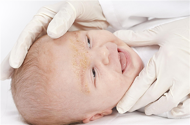 Gelbe Flecken auf dem Kopf eines Kindes - was ist das, welche Art von Krankheit