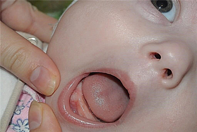 Bir çocukta diş etinde bir yumru - görünümün olası nedenleri