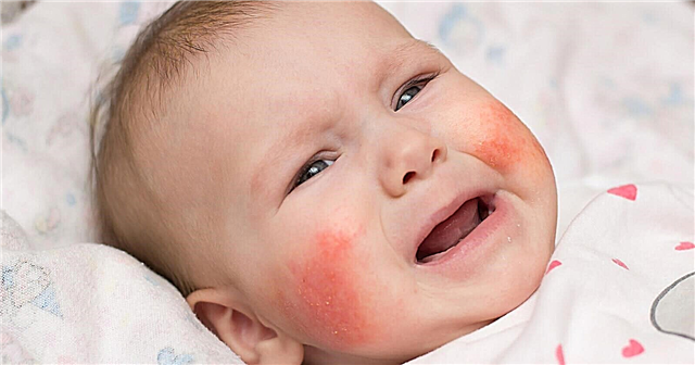 Červená kůže u novorozence - důvody, kdy zčervenání projde