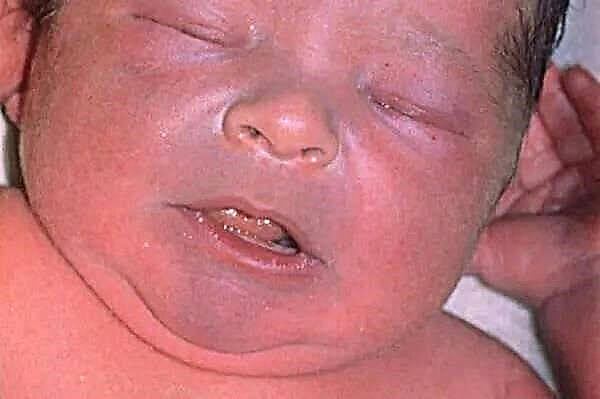 משולש nasolabial כחול אצל תינוק שזה עתה נולד - גורם לשינוי צבע כחול