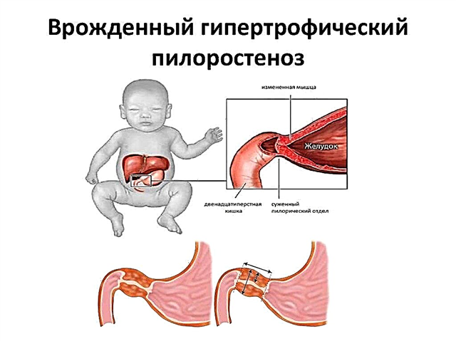 Pylorus stenosis újszülöttekben - okok, tünetek, diagnózis
