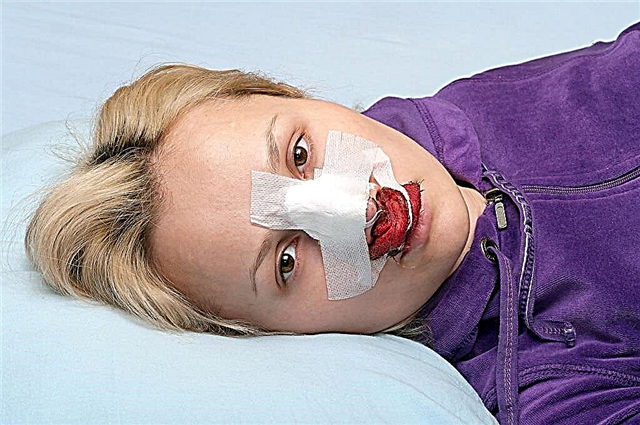 Známky zlomeného nosa u dieťaťa - ako identifikovať zlomeninu