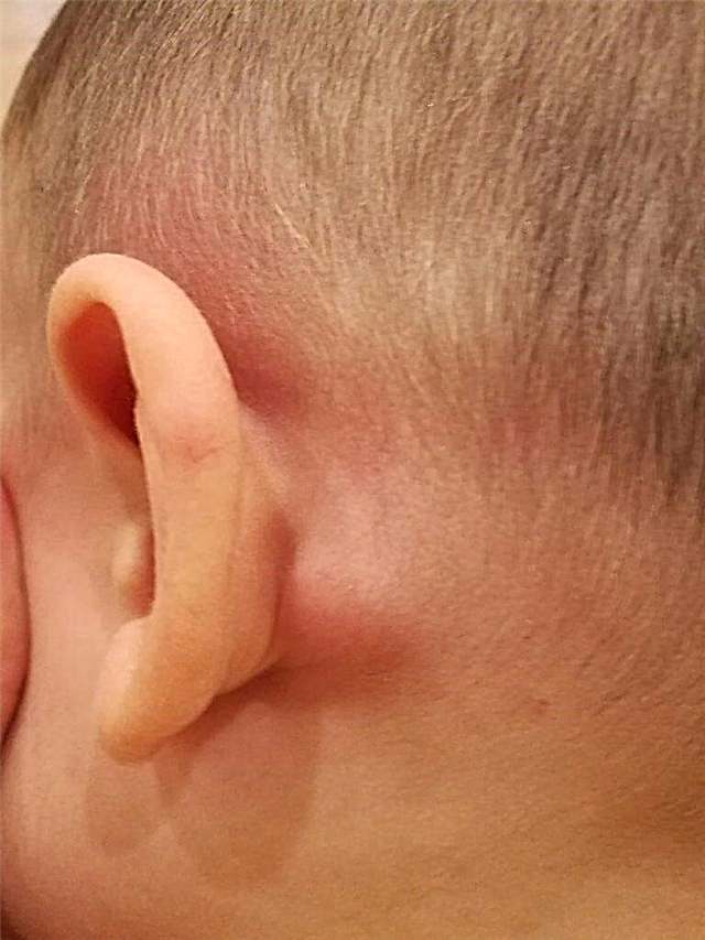 Шишка за вухом у дитини - причини появи