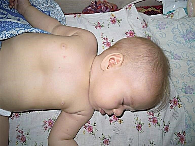 Sunken chest in a child - cause and treatment