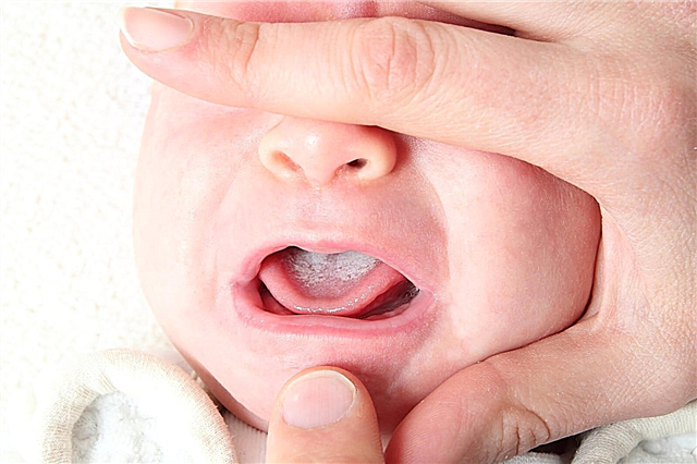 Kodėl burnos opos pasireiškia vaikui iki vienerių metų
