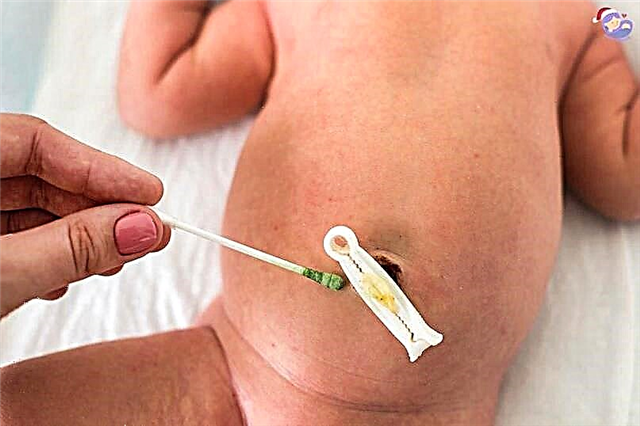 Navel in a newborn - the timing of the healing of the umbilical wound