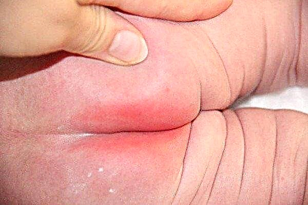 Cómo manejar correctamente la dermatitis del pañal en los recién nacidos
