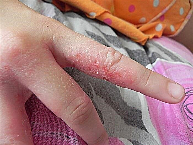 Waarom heeft een kind gebarsten vingers?