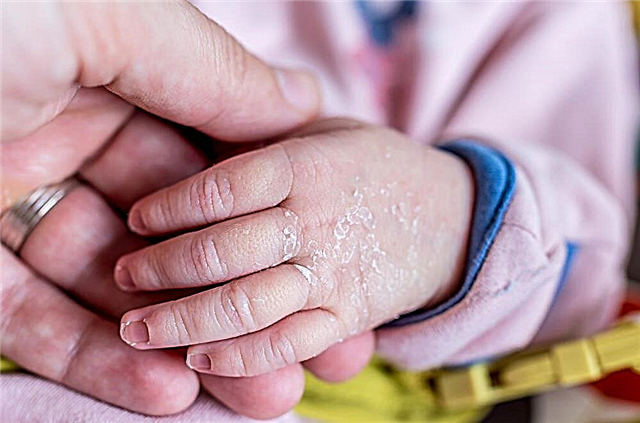 Proč suchá kůže u dítěte - důvody, jak zvlhčit