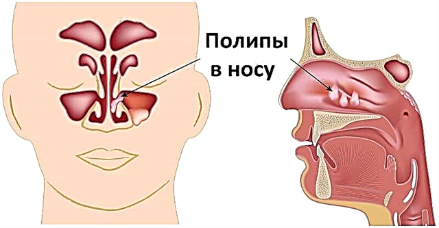 Polypes dans le nez d'un enfant - qu'est-ce que c'est, symptômes de croissance
