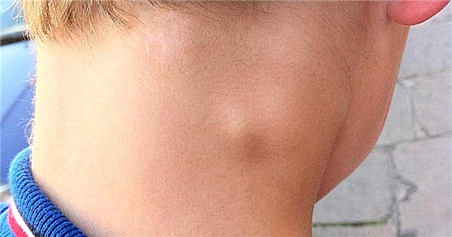 एक बच्चे की गर्दन पर एक गांठ - एक सील का कारण बनता है