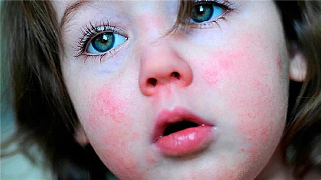 3 triệu chứng chính của bệnh ban đỏ ở trẻ em