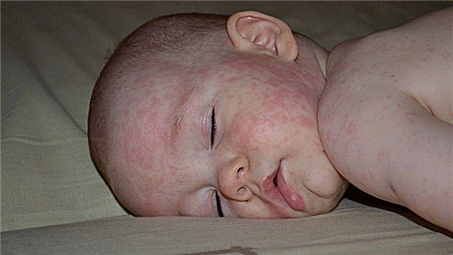 5 biến chứng nghiêm trọng của bệnh rubella ở trẻ em và người lớn