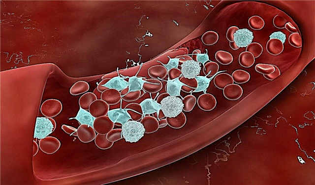 7 možnih vzrokov za visoko raven trombocitov v krvi pri otrocih