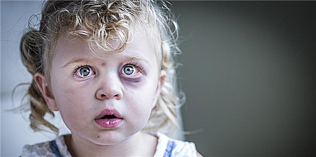 12 häufige Ursachen für Blutergüsse unter den Augen eines Kindes