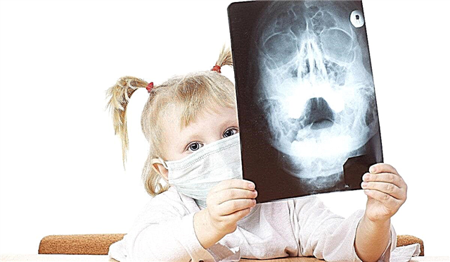 7 indikationer for røntgenbilleder hos børn og hyppigheden af ​​proceduren