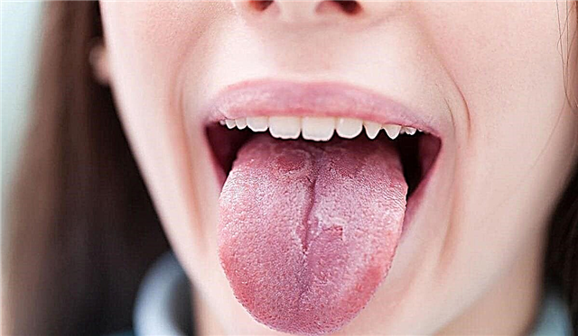 6 typer av fläckar på barnets tunga