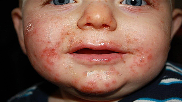 12 vanlige symptomer på enterovirusinfeksjon hos barn