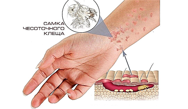 5 main groups of drugs for the treatment of scabies in children