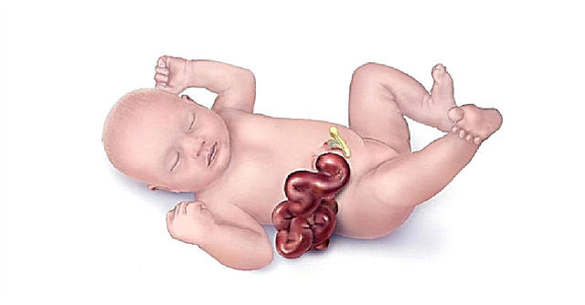 5 osnovnih pristopov k zdravljenju fetalne gastroschisis