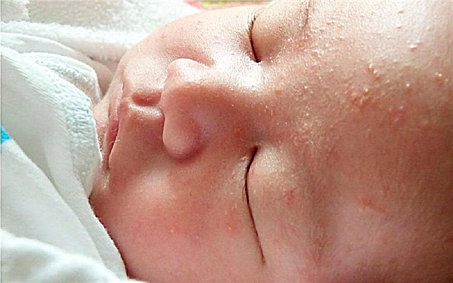 6 манифестација помоћу којих можете идентификовати Стапхилоцоццус ауреус код новорођенчади