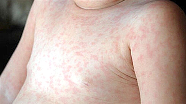 子供の12種類の発疹とこの状態の治療方法