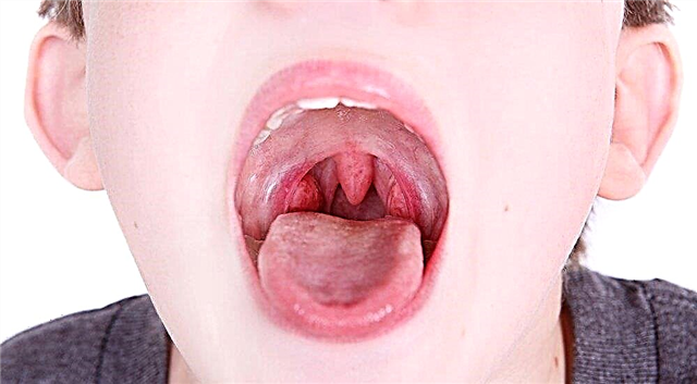 Competent approach to the treatment of pharyngitis in children