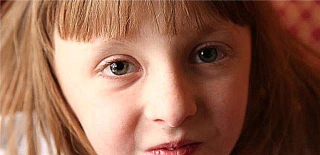 Kõik, mida vanemad peavad teadma lapse Šereshevski-Turneri sündroomi kohta