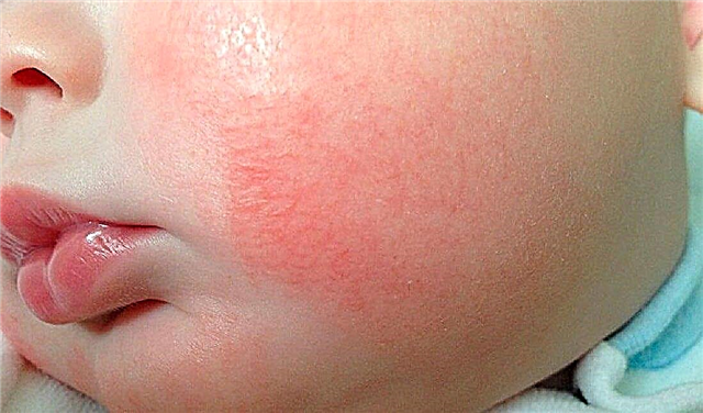 Las principales causas y signos de la dermatitis en un niño, que es importante conocer