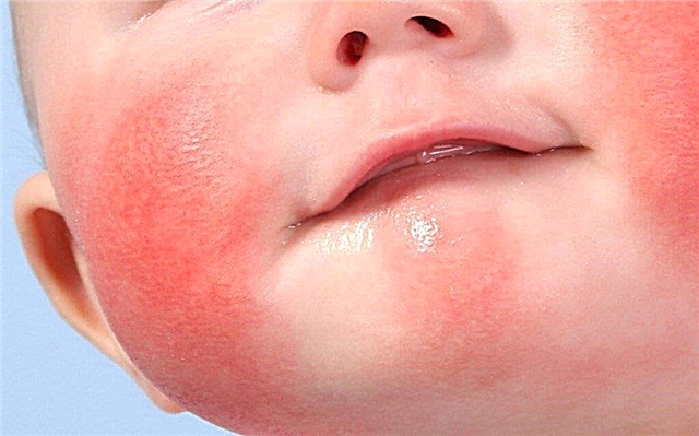 5 ways of treating exudative-catarrhal diathesis in children in the article of a practicing pediatrician