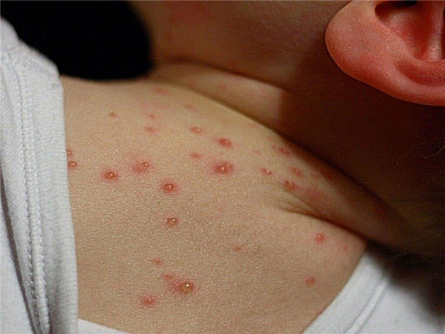 O que fazer se a febre em uma criança for acompanhada de erupção na pele?