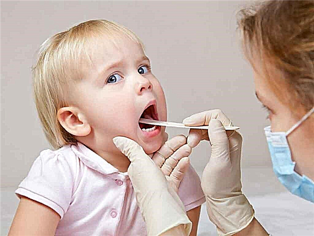 Cos'è l'angina lacunare? Il pediatra racconta il corso e il trattamento del mal di gola lacunare nei bambini