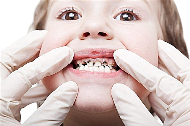 Ο παιδίατρος λέει για το πώς αλλάζουν τα δόντια στα παιδιά και ποια χαρακτηριστικά είναι σημαντικό να γνωρίζουμε