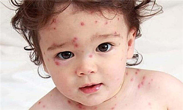 9 important things parents need to know about the measles vaccine