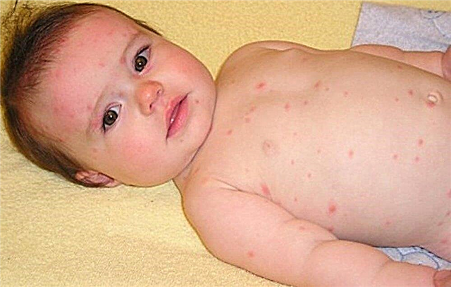 Uma criança pode pegar varicela pela segunda vez? O pediatra diz