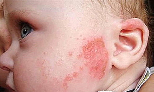 طبيب أطفال حول العقدية الجلدية عند الأطفال. كيفية التعرف على (9 أعراض رئيسية) وكيفية علاج المرض عند الطفل؟