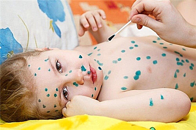 Како утврдити да ли дете има варицеле? Савети педијатра родитељима о дијагнози и лечењу водених козица