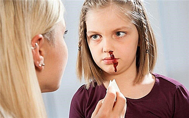 17 causes of nosebleeds in a child and 6 ways to prevent it