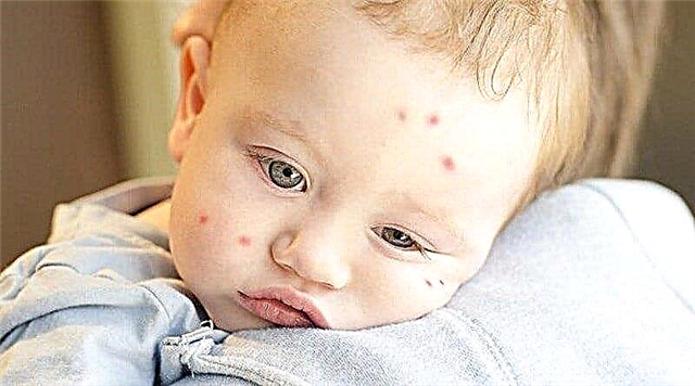 Zašto su ugrizi komaraca opasni za dječje oči?
