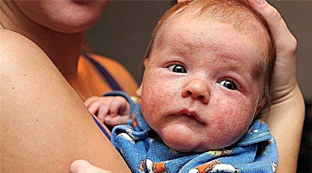 Sådan identificeres diatese hos et spædbarn: en allergolog fortæller