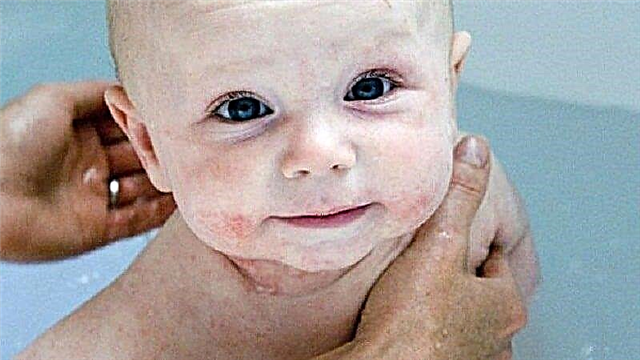 9 metode de tratare a eczemelor la un copil de la un alergolog pediatru