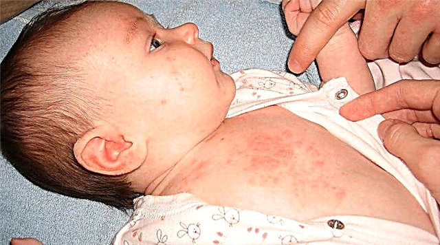 O que fazer se uma criança for alérgica a sabão em pó?