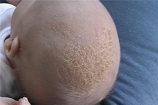 Причини появи кірочок на голові у немовляти і 3 способи їх видалення