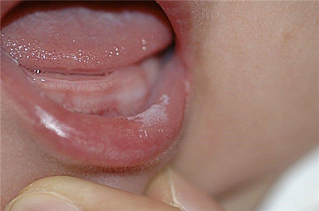 Causes possibles de la langue blanche et 3 façons de la nettoyer chez les bébés