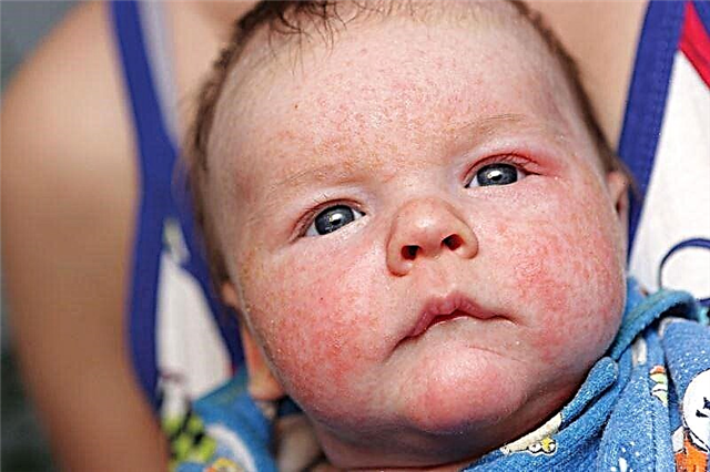 Цъфтяща кожа на новородени: 7 правила за грижа за дете с акне